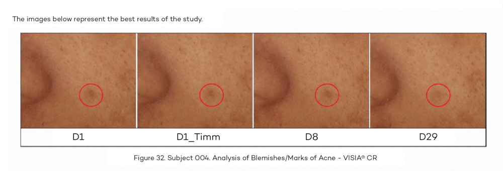 da_actine renov_piel marcas de acne