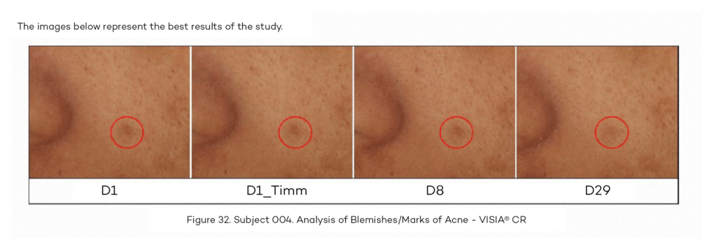da_actine renov_piel marcas de acne