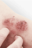 Dermatite atopique