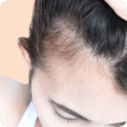 Alopécie réactionnelle