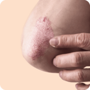 Psoriasis