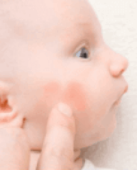 photo eczéma bebe