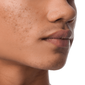 Que faut-il savoir sur l'acné