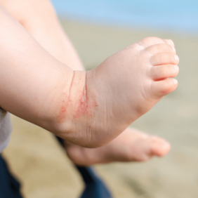 Comment prendre soin de la peau atopique de mon enfant ?