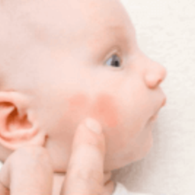 photo eczéma bebe