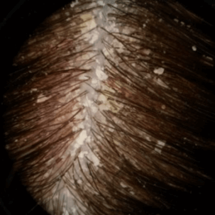 cabello_escamas_1