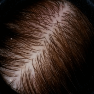 cabello_escamas_2