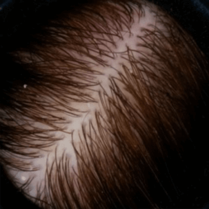 cabello_escamas_2