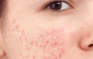 Acne