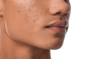 Que faut-il savoir sur l'acné