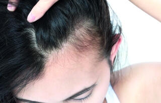 ALOPECIE AIGUE