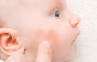photo eczéma bebe
