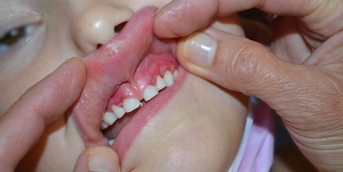 Gencives douloureuses  Ajouter une colonne