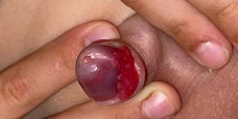 botriomycome