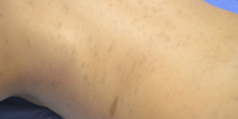 Cause rare d'hyperpigmentation chez l'enfant