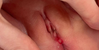 MM