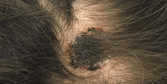 alopecie