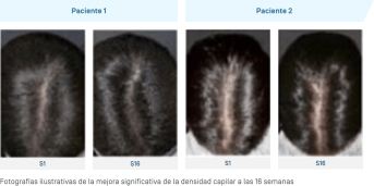 ES-Anaphase · Amélioration densité capillaire.png
