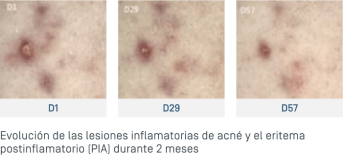 ES-Keracnyl Serum - Evolution lésions.png