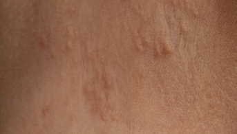 Dermatose polymorphe