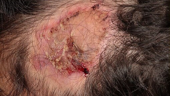 alopecie
