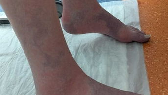 Tricolour dermatosis 1