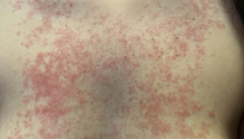 Dermatose inflammtoire du tronc ketorash 1