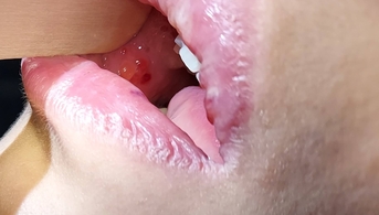 Des bulles muqueuses initiales