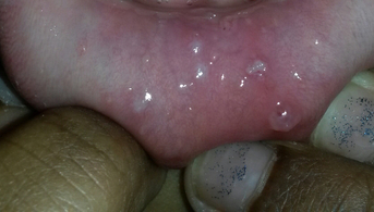 BlisterRed