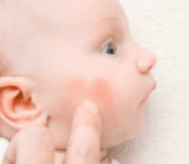 photo eczéma bebe