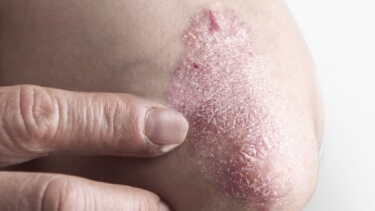 Psoriasis