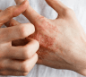 du_dexyane_eczema_silo_l3_header_eczema-hand
