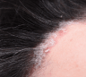 du_kertylol-pso_silo_psoriasis_areas_l3_pso-hair-scalp