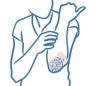 Psoriasis